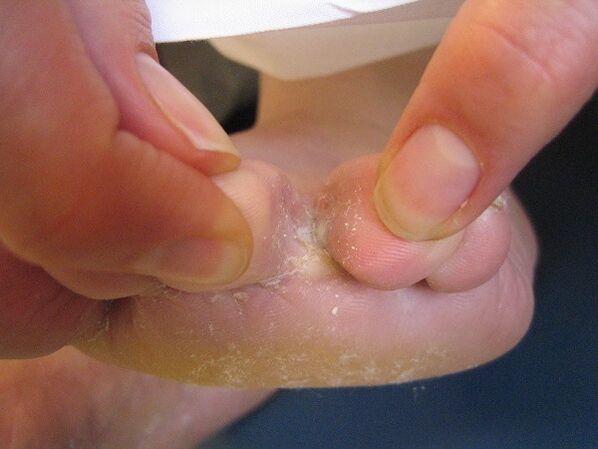 tratament complex al ciupercilor de pe picioare și unghii)